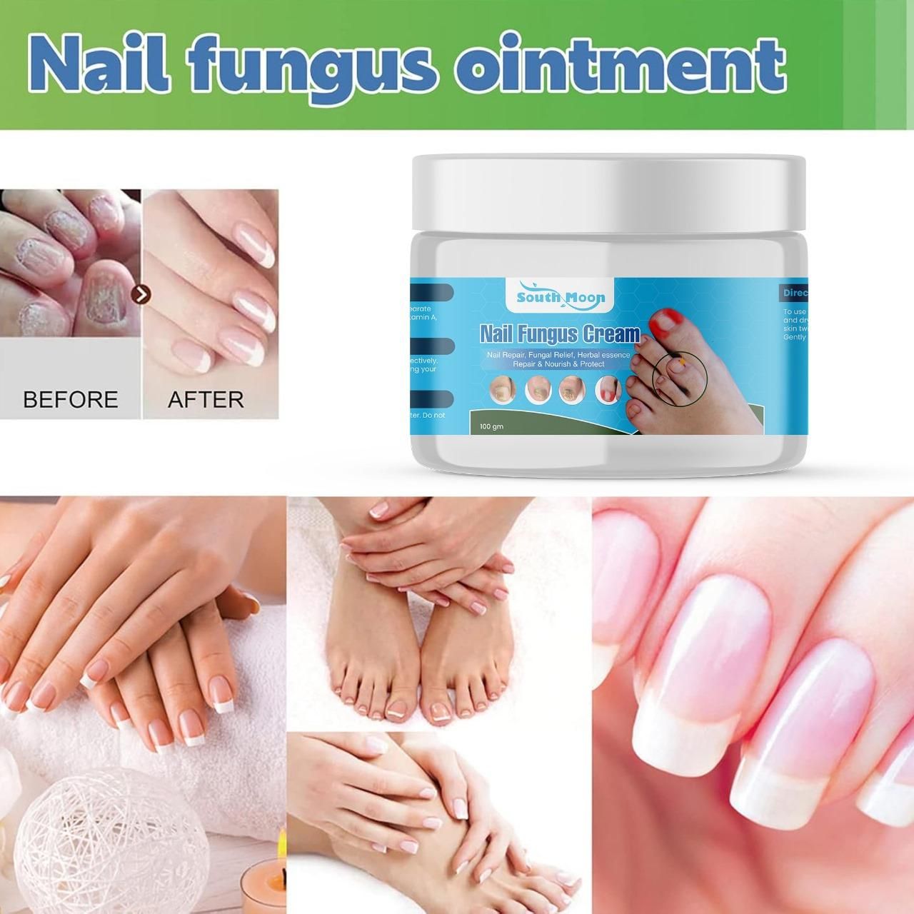 Nail Fungus Treatment Cream 100gm (Pack Of 2)